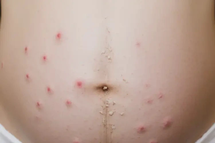 孕婦肚子上有濕疹可以徹底自愈嗎(圖4)