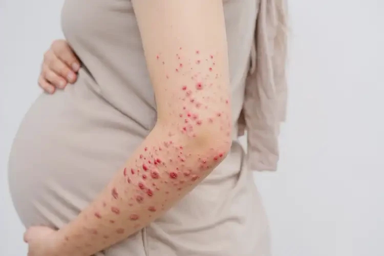 孕婦手臂容易長(zhǎng)濕疹不管它會(huì)自己好嗎(圖4)