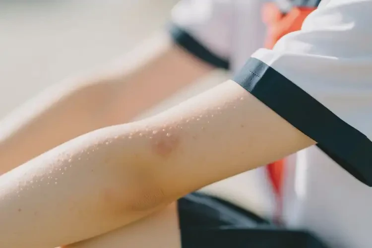 中學(xué)生手臂上偶爾起濕疹能徹底自愈嗎(圖1)