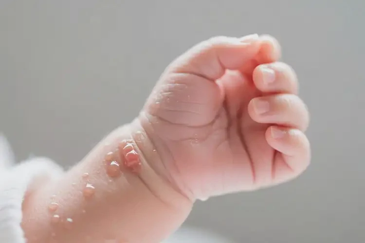 新生兒手臂經(jīng)常起濕疹不管它會(huì)自己自愈嗎(圖2)