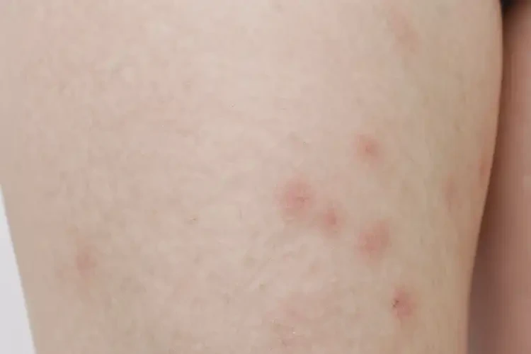 青少年大腿上起濕疹不管它會(huì)自己好嗎(圖3)