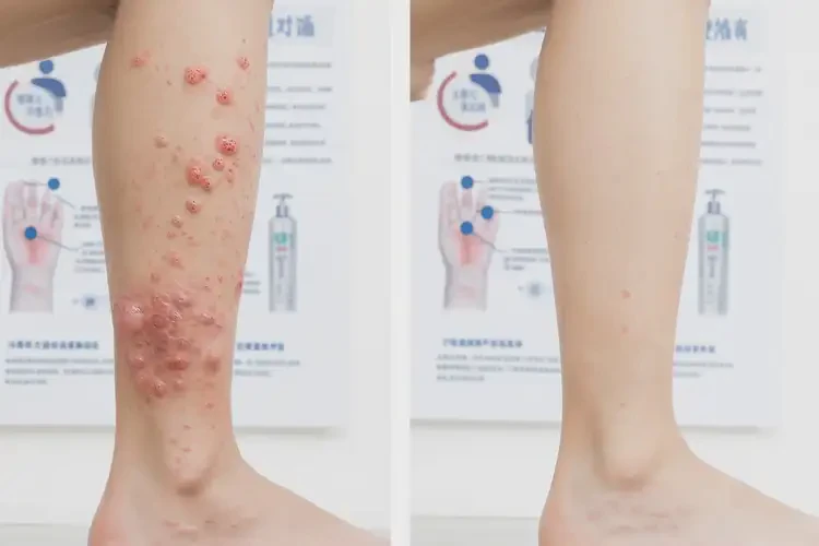 青少年腳上經(jīng)常長濕疹不管它會自己自愈嗎(圖1)