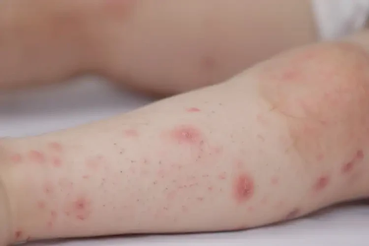 少兒屁股偶爾起濕疹可不可以徹底自愈(圖4)