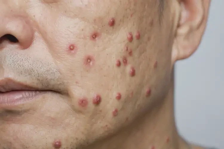 男人脖子偶爾長濕疹不管它會自己好嗎(圖4)