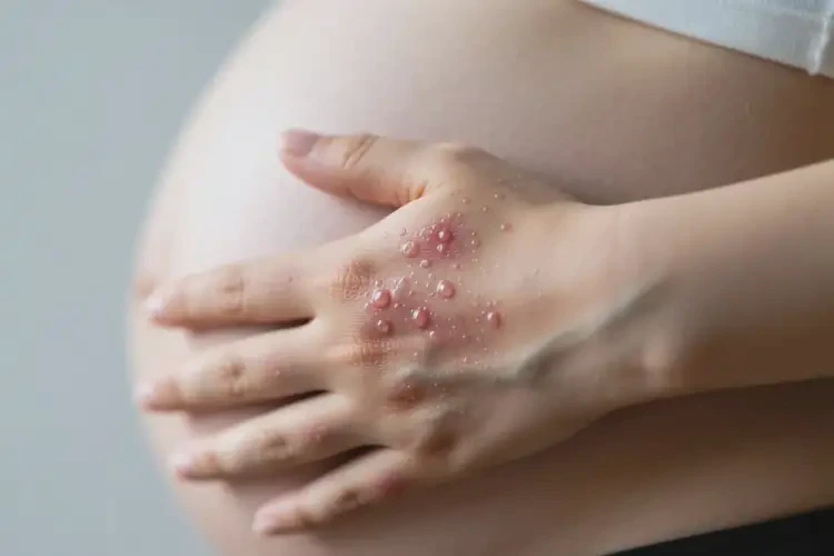 孕婦手上出現(xiàn)濕疹不管它會自己痊愈嗎(圖2)
