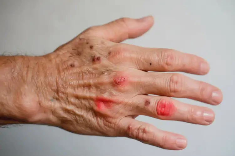 老人手上偶爾長(zhǎng)濕疹不管它會(huì)自己好嗎(圖2)