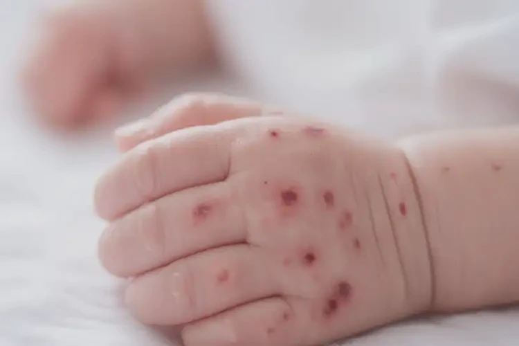 新生兒手上經(jīng)常長濕疹能靠自己自愈嗎(圖4)