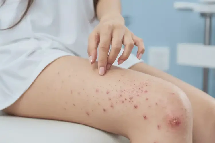 女生大腿上容易長濕疹不管它會自己自愈嗎(圖4)