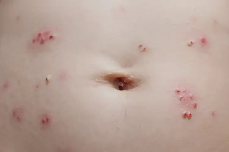 幼儿肚子上出湿疹能彻底自愈吗(图4)