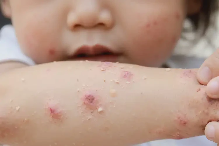 少兒手臂出濕疹能靠自己自愈嗎(圖4)