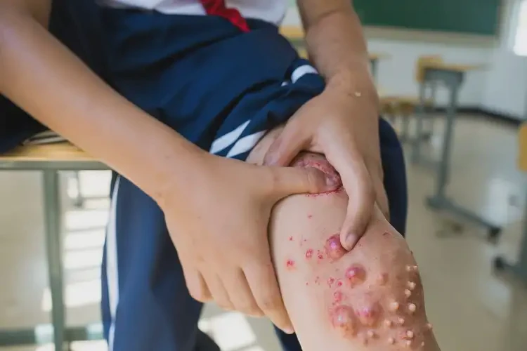 中學(xué)生大腿有濕疹不管它會自己自愈嗎(圖4)