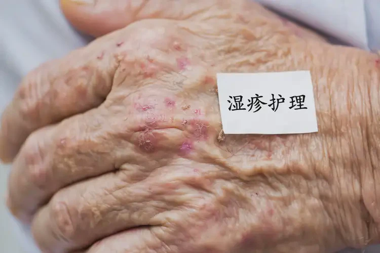 老年人屁股起濕疹不管它會自己自愈嗎(圖4)