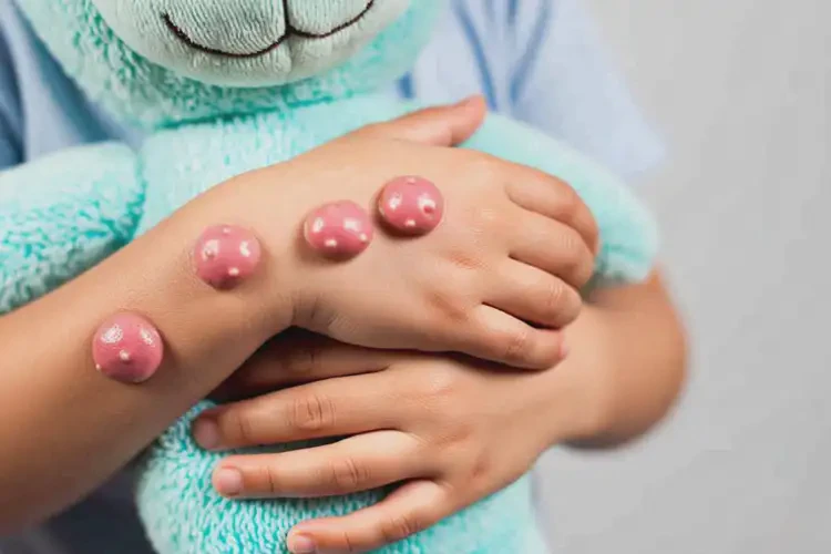 孩子全身有湿疹不管它会自己好吗(图3)