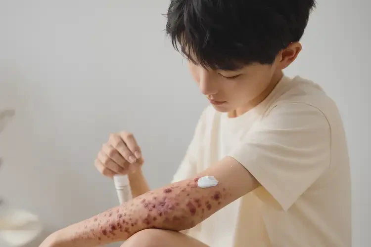 青少年手臂上容易長(zhǎng)濕疹可以徹底自愈嗎(圖3)