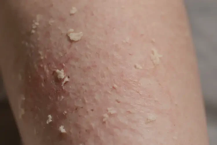 小兒小腿容易起濕疹不管它會(huì)自己痊愈嗎(圖4)