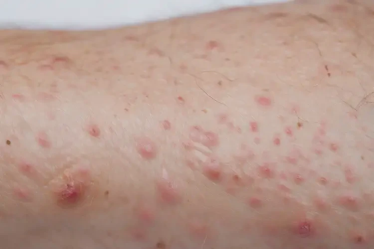 老年人手臂上偶爾長濕疹不管它會自己好嗎(圖4)