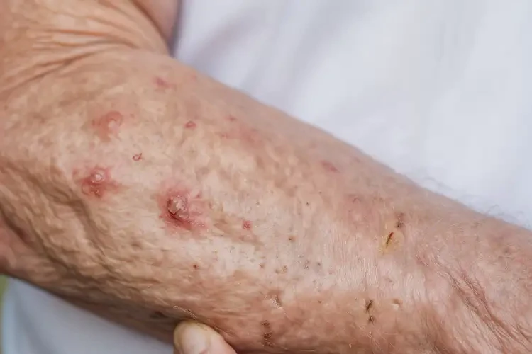 老年人手臂有濕疹可不可以徹底自愈(圖3)