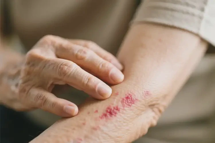 老人全身偶爾起濕疹能徹底自愈嗎(圖1)