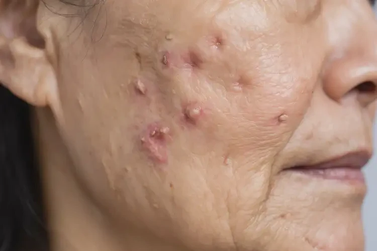 男生面部長(zhǎng)濕疹不管它會(huì)自己自愈嗎(圖4)