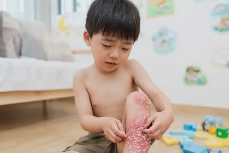 少兒大腿起濕疹不管它會自己自愈嗎(圖3)