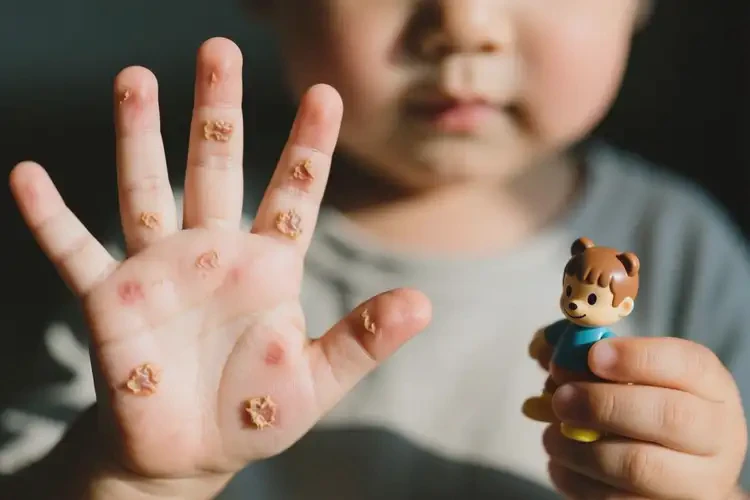 小孩手上偶爾長(zhǎng)濕疹不管它會(huì)自己痊愈嗎(圖1)