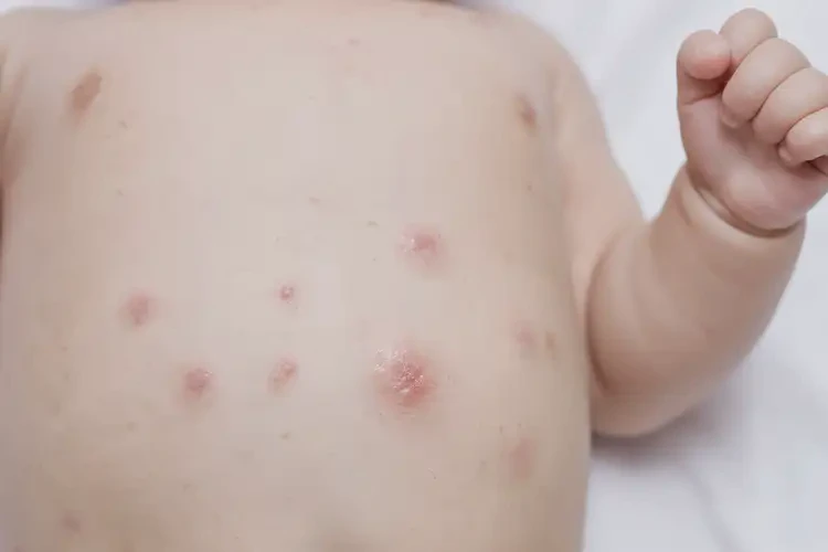 嬰兒肚子上出濕疹能靠自己自愈嗎(圖4)