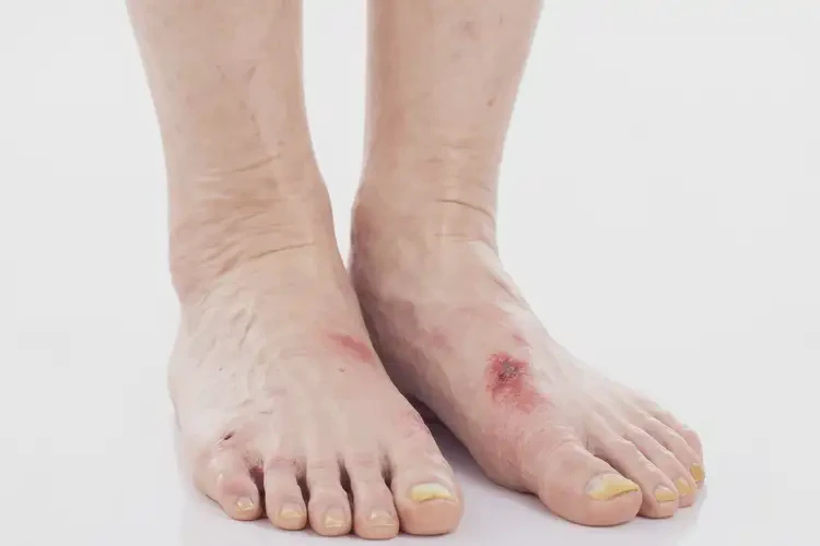 老年人腳上經(jīng)常長(zhǎng)濕疹能不能徹底自愈(圖2)