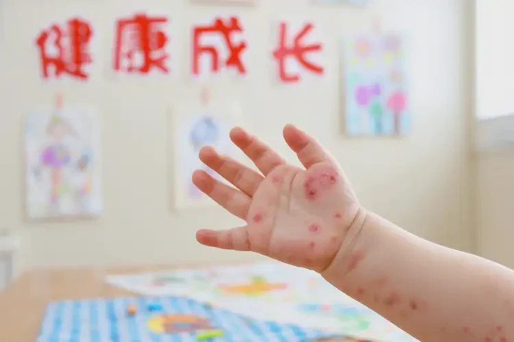 少兒手上出現(xiàn)濕疹不管它會(huì)自己痊愈嗎(圖4)