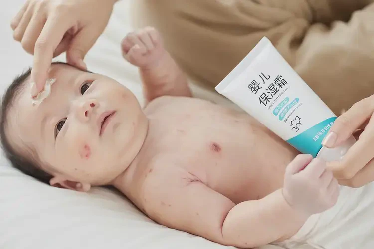 新生兒身上起濕疹能夠徹底治愈嗎(圖4)