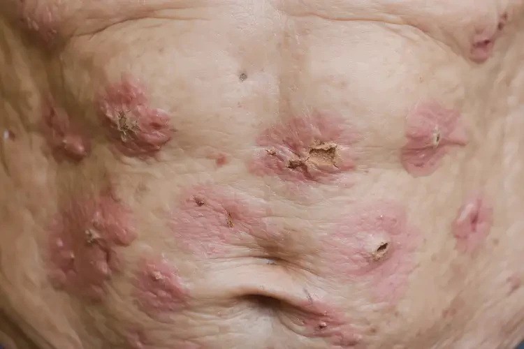 老年人肚子上容易起濕疹不管它會(huì)自己痊愈嗎(圖4)