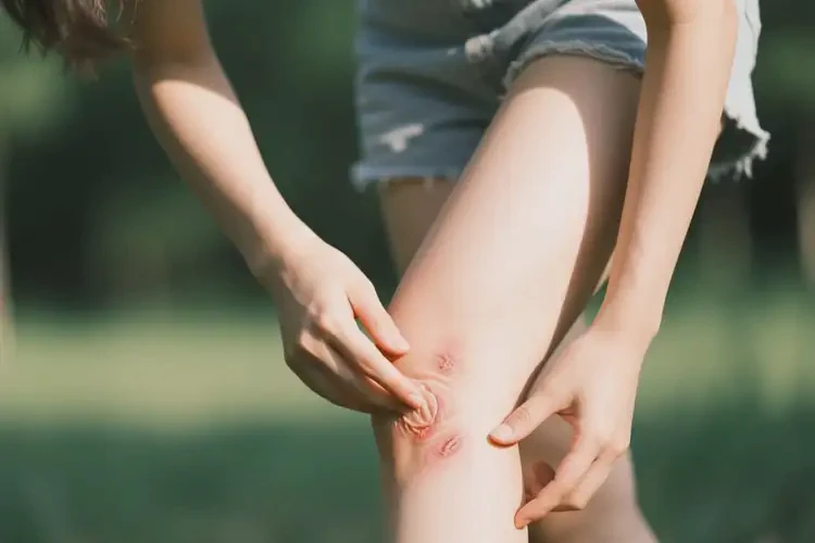 青年人小腿上經(jīng)常長(zhǎng)濕疹不管它會(huì)自己痊愈嗎(圖1)