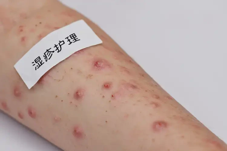 小孩全身容易起濕疹能徹底自愈嗎(圖4)