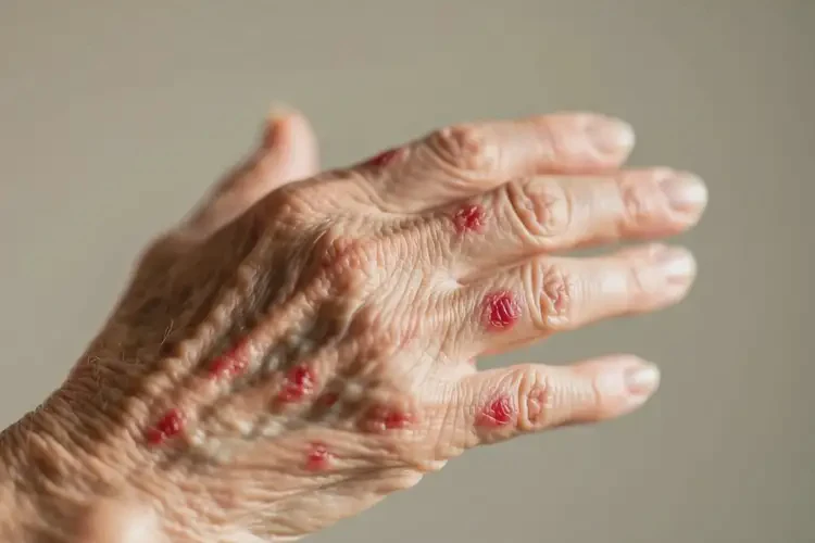 老人全身偶爾起濕疹能徹底自愈嗎(圖4)