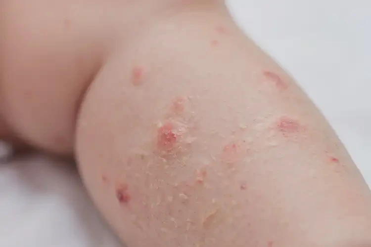 新生兒小腿起濕疹能靠自己自愈嗎(圖4)