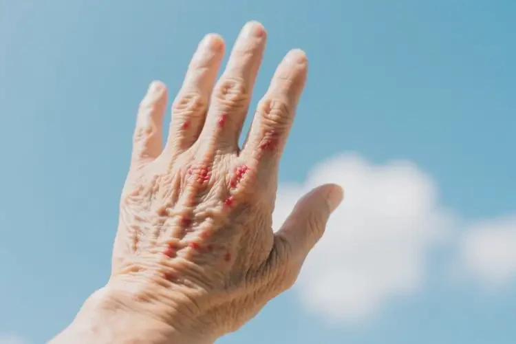 老人手上起濕疹能徹底自愈嗎(圖2)