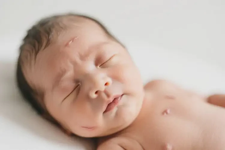 新生兒面部有濕疹不管它會自己自愈嗎(圖3)