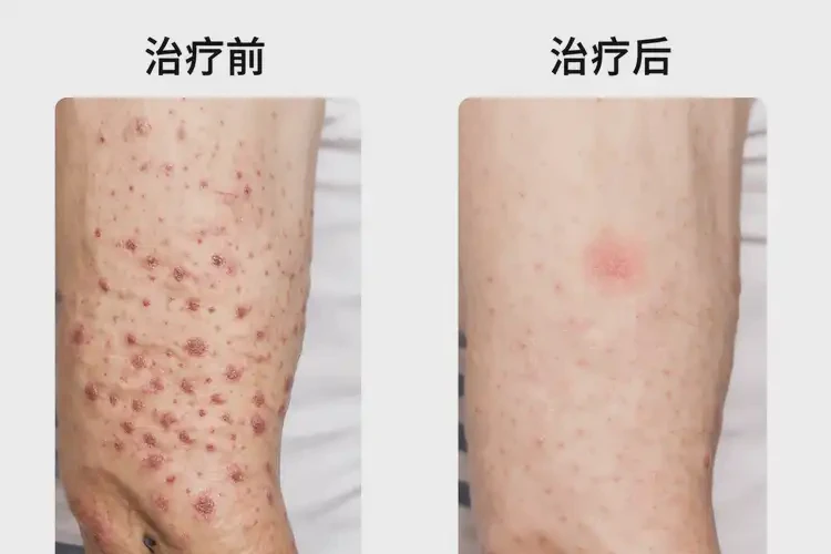 老年人全身起濕疹不管它會(huì)自己好嗎(圖2)