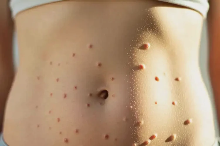 女生肚子上偶爾長濕疹不管它會(huì)自己自愈嗎(圖4)