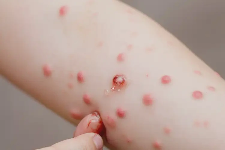 孩子手臂上經(jīng)常起濕疹可不可以徹底自愈(圖4)