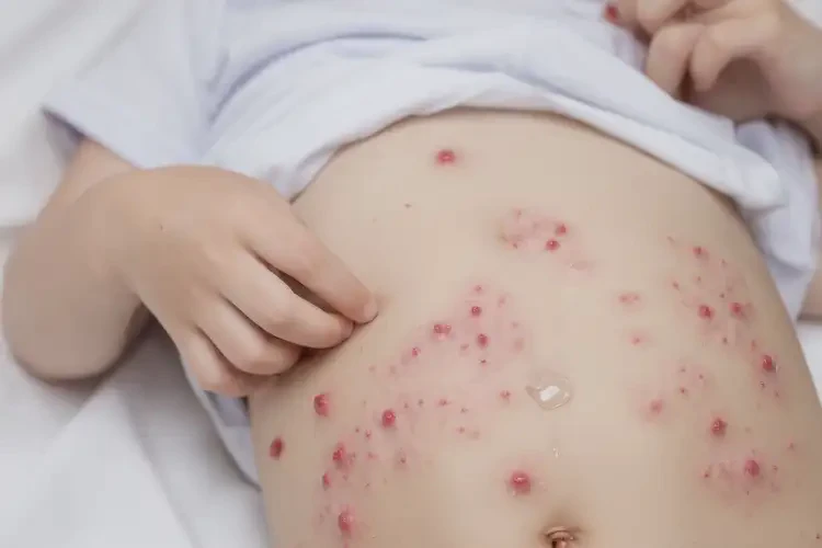 少兒肚子上偶爾長(zhǎng)濕疹能夠徹底治愈嗎(圖4)