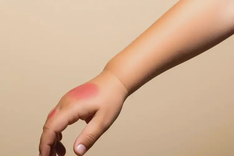 小孩四肢經(jīng)常起濕疹不管它會自己好嗎(圖4)