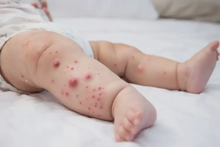 寶寶四肢經(jīng)常長濕疹能徹底自愈嗎(圖4)