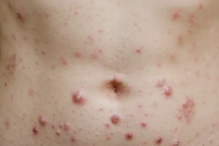 女生肚子經(jīng)常長濕疹能夠徹底治愈嗎(圖4)