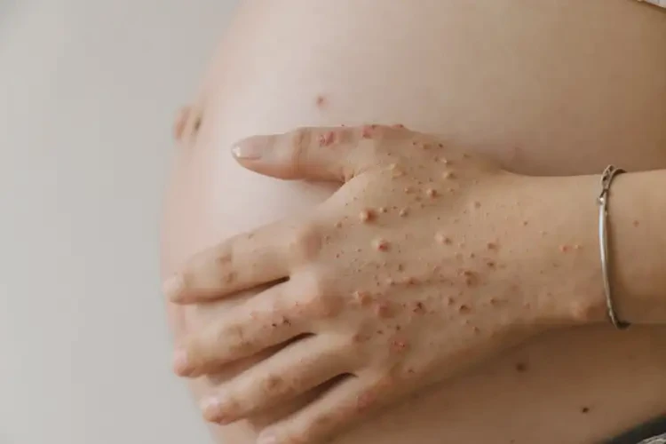 孕婦手上出濕疹可不可以徹底自愈(圖4)