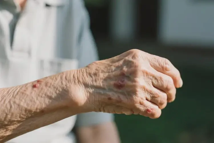 老人手臂上偶爾起濕疹不管它會(huì)自己痊愈嗎(圖1)