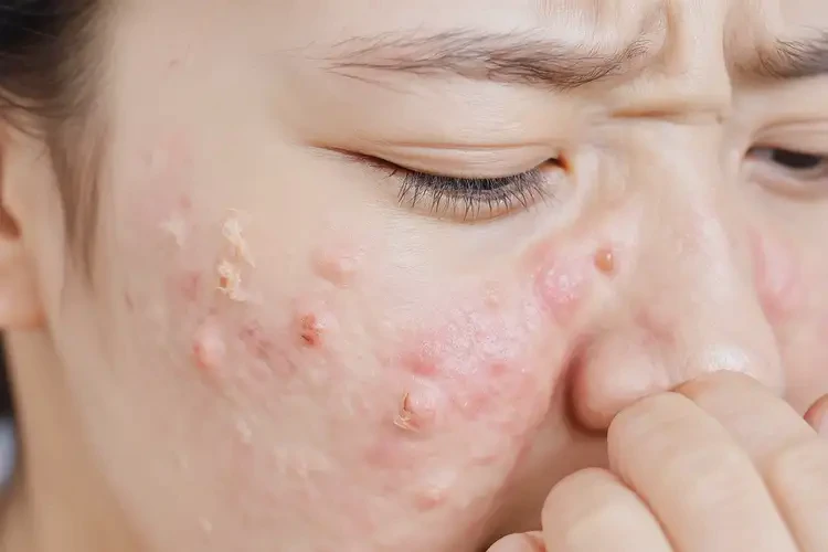 孕妇脸上长湿疹能够彻底治愈吗(图4)