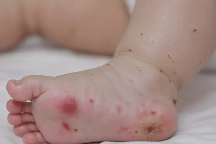嬰幼兒腳上有濕疹能徹底自愈嗎(圖4)