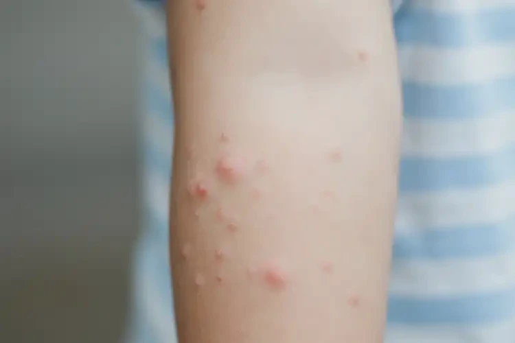 小兒手臂上容易起濕疹不管它會(huì)自己痊愈嗎(圖4)