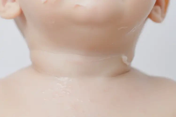 嬰兒脖子經(jīng)常起濕疹可以徹底自愈嗎(圖3)