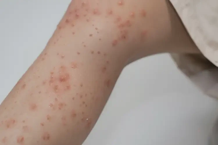 中學(xué)生小腿容易起濕疹不管它會自己好嗎(圖3)